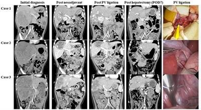 Case report: Portal vein ligation: lessons from patients with PRETEXT III hepatoblastoma in restoring future liver remnant before major hepatectomy and literature review